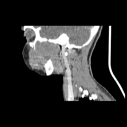Carcinoma of the maxillary antrum (Radiopaedia 53805-59888 Sagittal C+ delayed 55).jpg