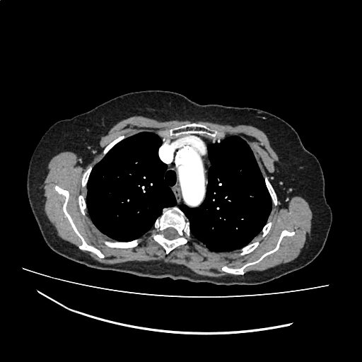File:Cardiac hydatid disease (Radiopaedia 64684-73611 Axial with contrast 11).jpg