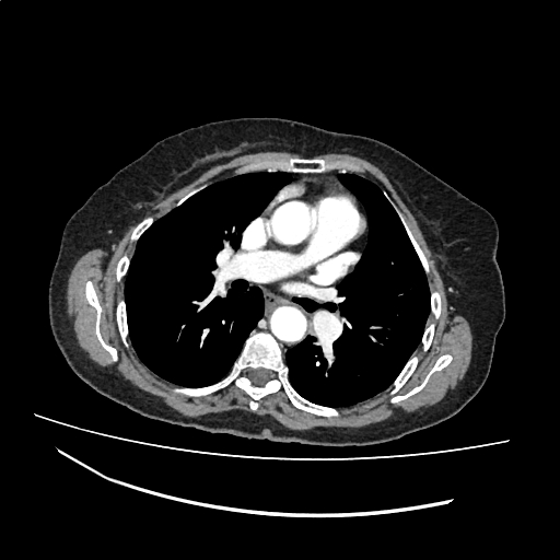 File:Cardiac hydatid disease (Radiopaedia 64684-73611 Axial with contrast 21).jpg