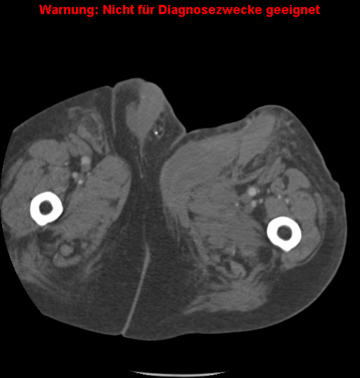 File:Cardiac perforation following transcatheter aortic valve implantation (Radiopaedia 23714-23863 B 25).png