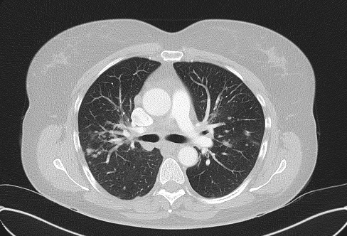 Cardiac sarcoidosis (Radiopaedia 74548-85534 Axial lung window 34).jpg