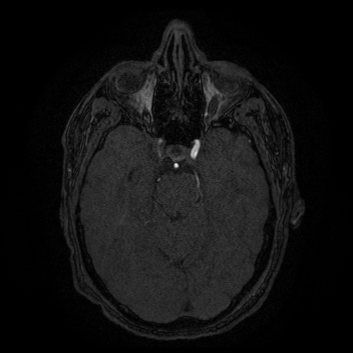 Carotid arterial dissection with acute cerebral infarction (Radiopaedia 26636-26784 MRA 110).jpg