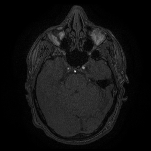 Carotid arterial dissection with acute cerebral infarction (Radiopaedia 26636-26784 MRA 119).jpg