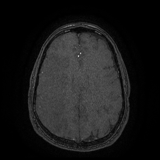Carotid arterial dissection with acute cerebral infarction (Radiopaedia 26636-26784 MRA 41).jpg