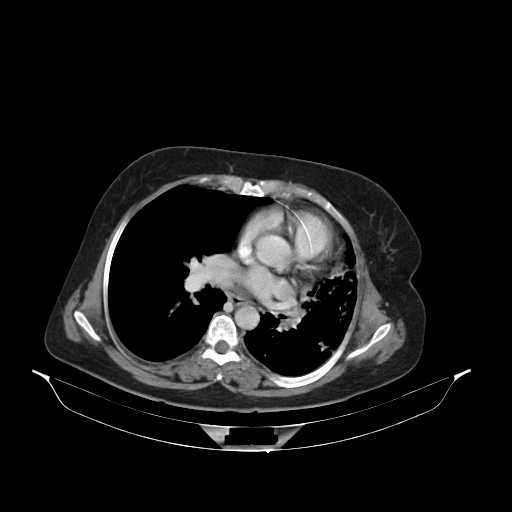 File:Carotid body tumor (Radiopaedia 21021-20948 B 42).jpg