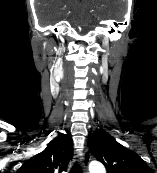 File:Carotid body tumor (Radiopaedia 39845-42300 C 55).jpg