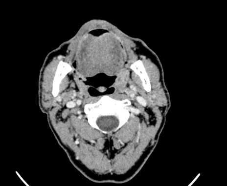 Carotid body tumor (Radiopaedia 61750-69757 Axial Post contrast 25).jpg