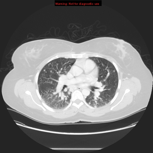 Carotid body tumor with lung metastases (Radiopaedia 9301-48390 Axial lung window 35).jpg