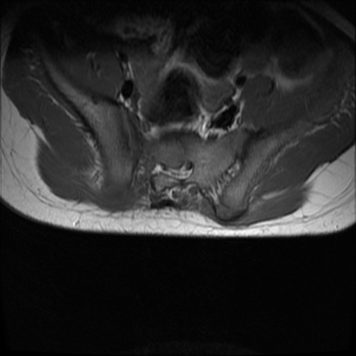 File:Caudal regression syndrome type 1 (Radiopaedia 82213-96267 Axial T1 23).jpg