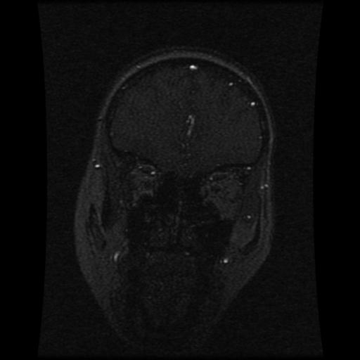 Cavernoma with developmental venous anomaly (Radiopaedia 22470-22507 MRV 101).jpg