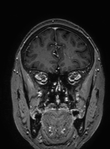Cavernous hemangioma of the cerebellar falx (Radiopaedia 73025-83724 Coronal T1 C+ 97).jpg