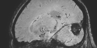 Cavernous hemangioma of the cerebellar falx (Radiopaedia 73025-83724 Sagittal BOLD 130).jpg