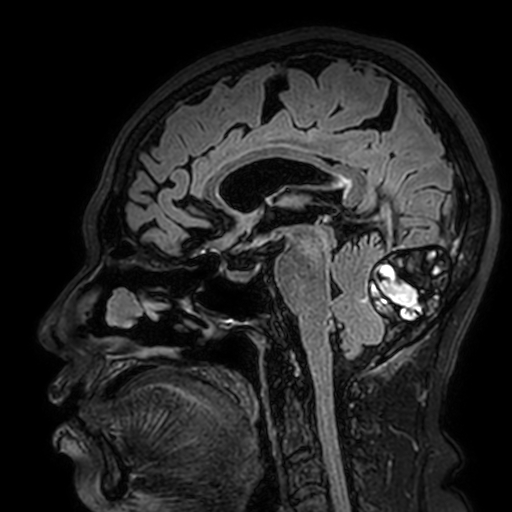 Cavernous hemangioma of the cerebellar falx (Radiopaedia 73025-83724 Sagittal FLAIR 103).jpg