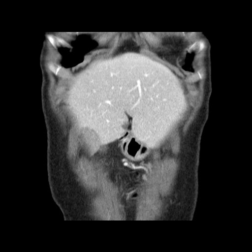 Cavernous hepatic hemangioma (Radiopaedia 75441-86667 C 26).jpg