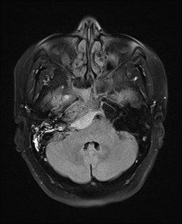 File:Cavernous sinus meningioma (Radiopaedia 63682-72367 Axial FLAIR 6).jpg