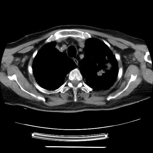 Cavitating pulmonary metastases (Radiopaedia 89545-106544 Axial non-contrast 10).jpg