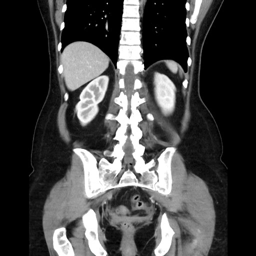 Cecal adenocarcinoma (Radiopaedia 75909-87331 B 37).jpg