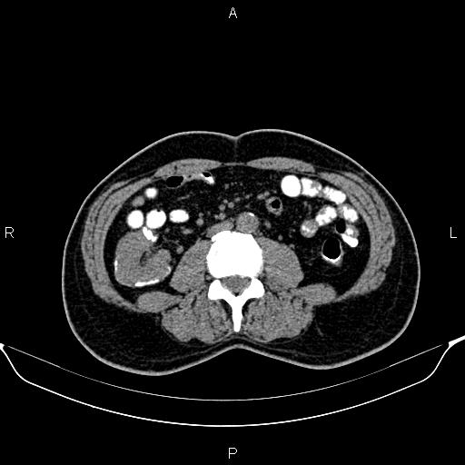 Cecal adenocarcinoma (Radiopaedia 85324-100916 Axial non-contrast 52).jpg