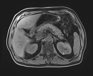 Cecal mass causing appendicitis (Radiopaedia 59207-66532 Axial T1 46).jpg