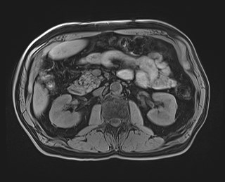 Cecal mass causing appendicitis (Radiopaedia 59207-66532 Axial T1 59).jpg