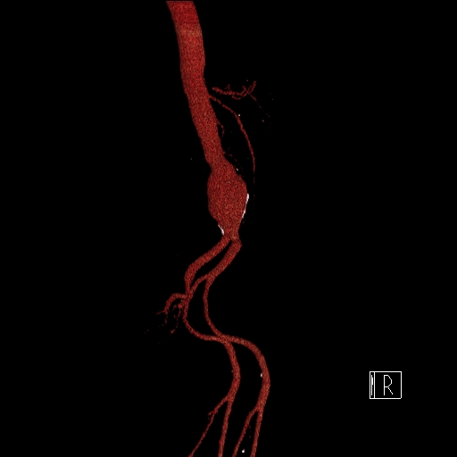 File:Celiac artery compression by the diaphragmatic crurae (Radiopaedia 31739-32666 3D CTA 6).jpg