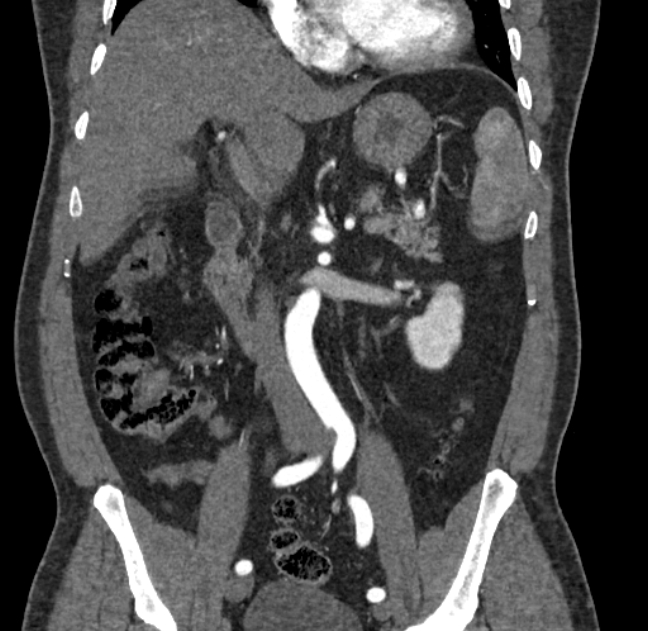 Celiac artery dissection (Radiopaedia 52194-58080 C 52).jpg