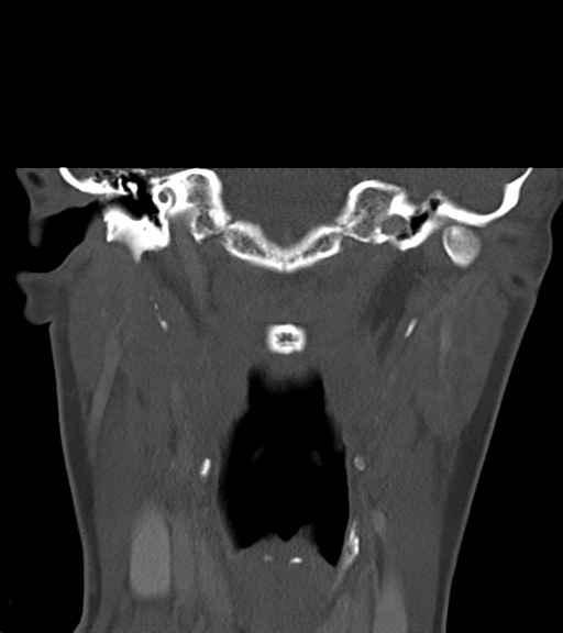 File:Cemento-ossifying fibroma (Radiopaedia 46243-50643 Coronal bone window 39).png
