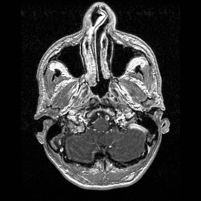 File:Central-variant posterior reversible encephalopathy syndrome (PRES) (Radiopaedia 43880-47358 Axial T1 C+ 11).jpg