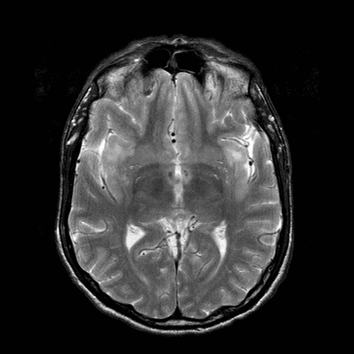 File:Central-variant posterior reversible encephalopathy syndrome (PRES) (Radiopaedia 43880-47358 Axial T2 11).jpg