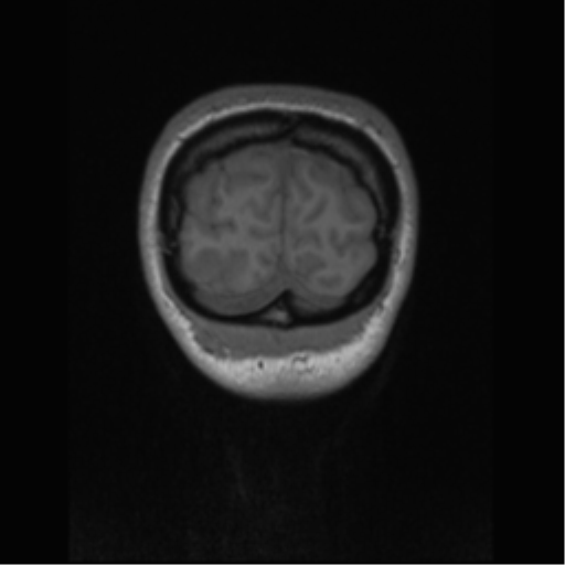 Central neurocytoma (Radiopaedia 37664-39557 Coronal T1 8).png