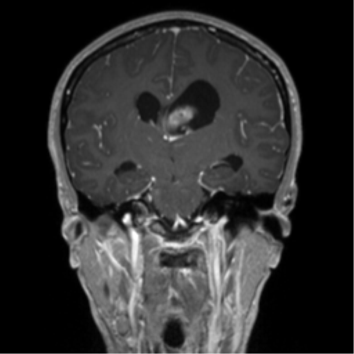 Central neurocytoma (Radiopaedia 37664-39557 Coronal T1 C+ 42).png