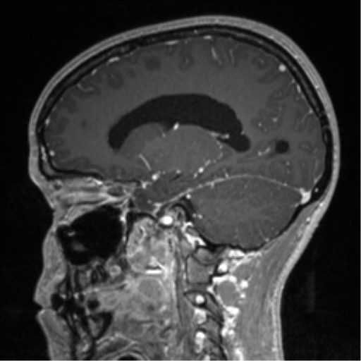 File:Central neurocytoma (Radiopaedia 37664-39557 Sagittal T1 C+ 60).png