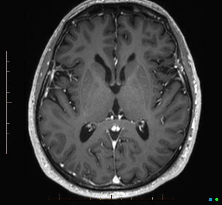 Cerebellar gangliocytoma (Radiopaedia 65377-74422 Axial T1 C+ 67).jpg