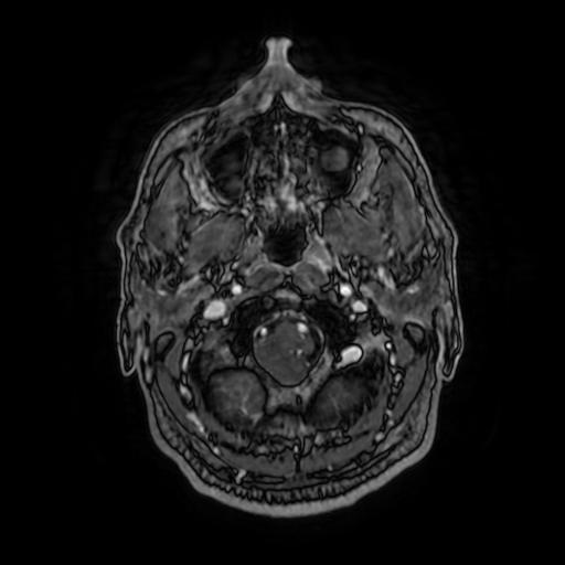 Cerebellar hemangioblastoma (Radiopaedia 88055-104622 Axial T1 C+ 30).jpg