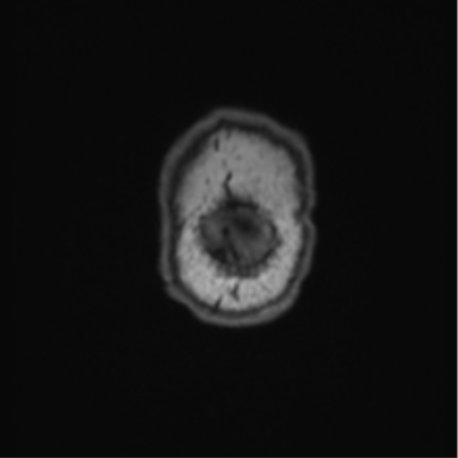File:Cerebellar hemangioblastomas and pituitary adenoma (Radiopaedia 85490-101176 Coronal T1 5).png