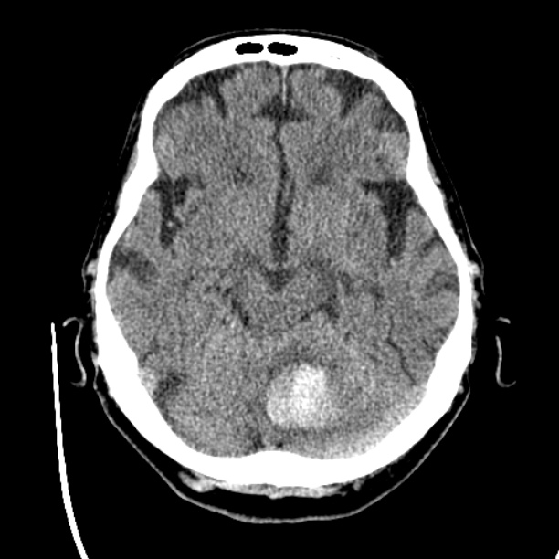 Cerebellar hemorrhage (Radiopaedia 27193-27359 Axial non-contrast 18).jpg