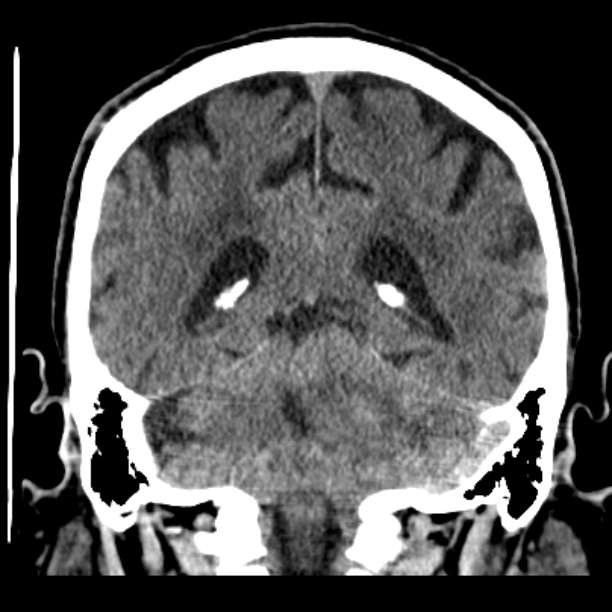 Cerebellar hemorrhage (Radiopaedia 27193-27359 Coronal non-contrast 39).jpg