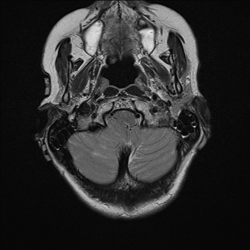 File:Cerebellar metastases (Radiopaedia 24038-24249 Axial T2 16).jpg