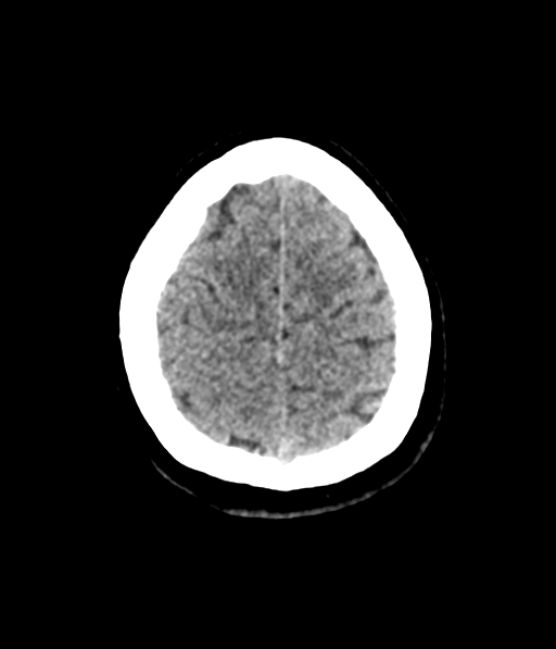 Cerebellar metastases - colorectal adenocarcinoma (Radiopaedia 40947-43652 Axial non-contrast 58).png