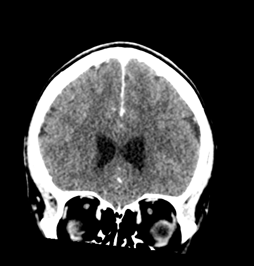 Cerebellar metastases - colorectal adenocarcinoma (Radiopaedia 40947-43652 Coronal C+ 30).png