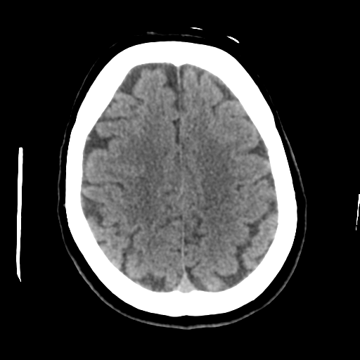 Cerebellar metastasis (cystic appearance) (Radiopaedia 41395-44258 Axial non-contrast 40).png