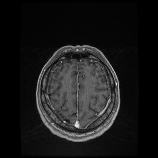 Cerebellar metastasis of pulmonary adenocarcinoma, cavernous venous malformation, and developmental venous anomaly (Radiopaedia 85827-101661 Axial T1 C+ 75).jpg