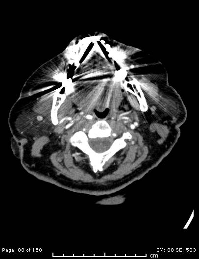 Cerebellar strokes due to intracranial giant cell arteritis (Radiopaedia 68799-78510 CT angiogram 88).jpg