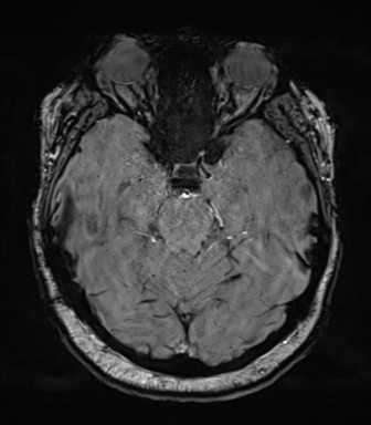 Cerebellopontine angle meningioma (Radiopaedia 48434-53348 Axial SWI 33).png