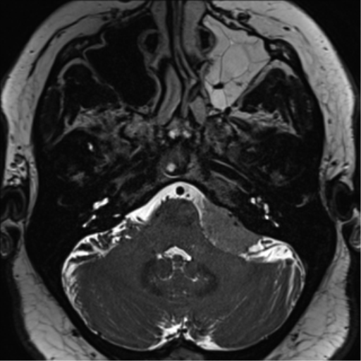 Cerebellopontine angle meningioma (Radiopaedia 48434-53348 Axial T2 Space 47).png