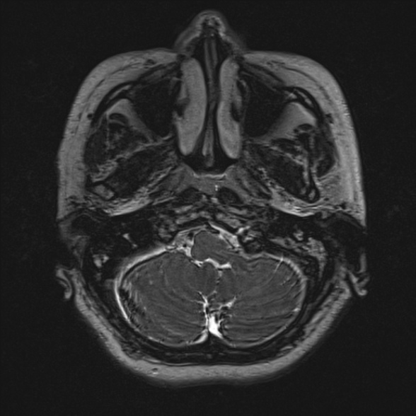 Cerebellopontine angle meningioma (Radiopaedia 53561-59591 Axial 3D volume T2 28).jpg
