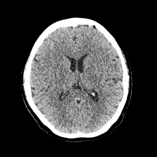 Cerebellopontine angle meningioma (Radiopaedia 53561-59592 Axial non-contrast 38).jpg