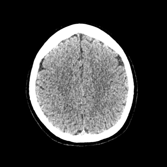 Cerebellopontine angle meningioma (Radiopaedia 53561-59592 Axial non-contrast 49).jpg