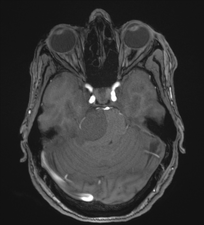 Cerebellopontine angle meningioma (Radiopaedia 72983-83680 Axial MRA 38).jpg