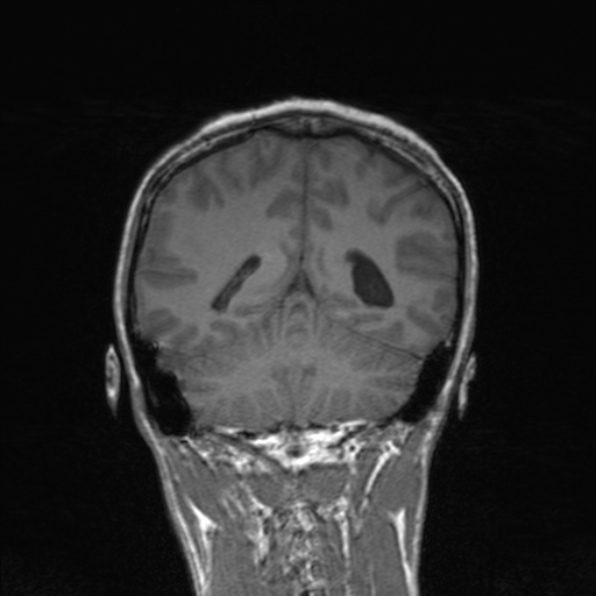 Cerebral abscess (Radiopaedia 24212-24478 Coronal T1 146).jpg